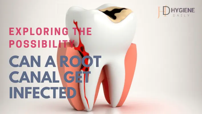 Can a Root Canal Get Infected